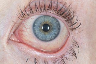 A red and watery eye caused by conjunctivitis